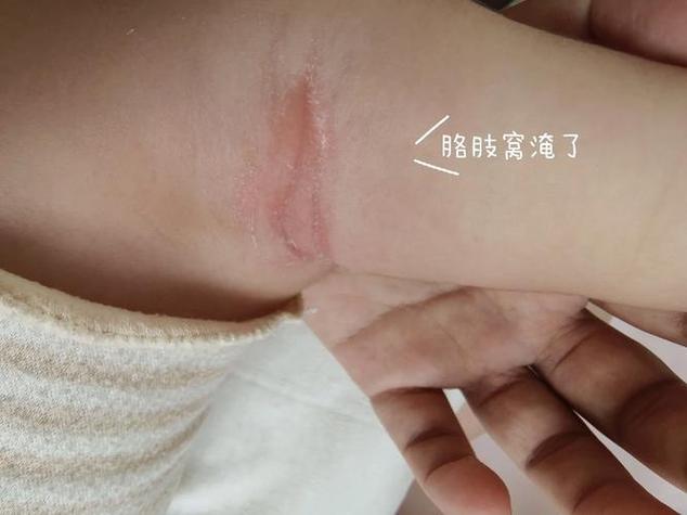 腋窝挠破了怎么办截图