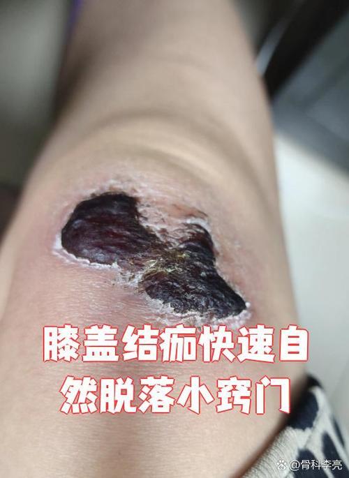 内裤上有黄褐色的结痂