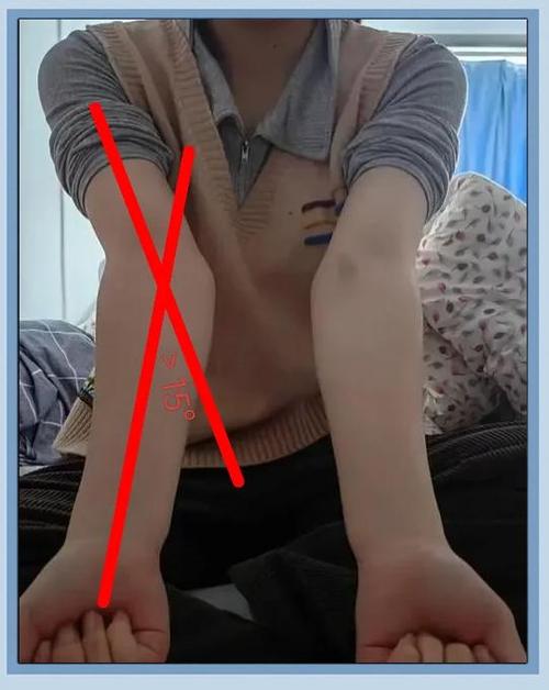 女孩手肘外翻图片