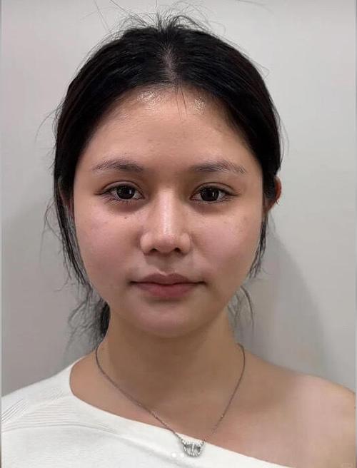 三次医美只做1次
