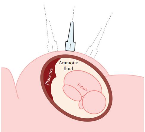 amniotic egg