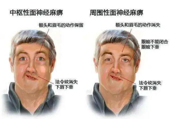 面瘫恢复顺口溜