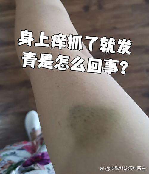 挠痒痒出现淤青