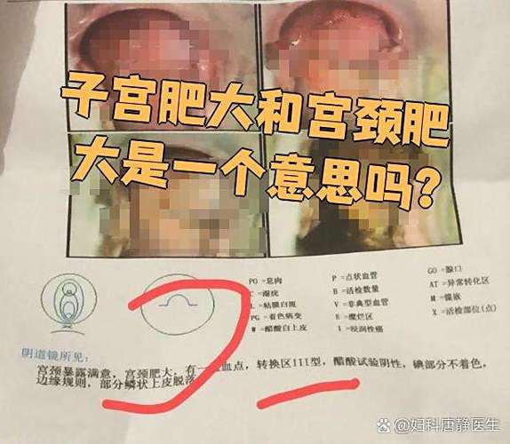 妇科肥大是什么原因