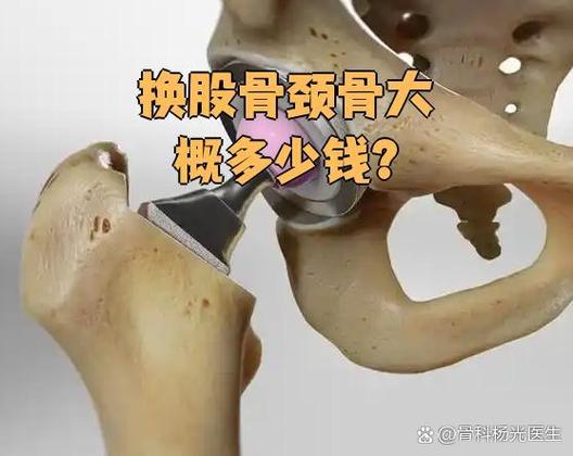 做股骨头手术大概需要多少钱截图