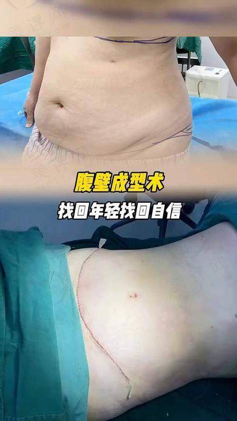 腹壁整形手术费用多少