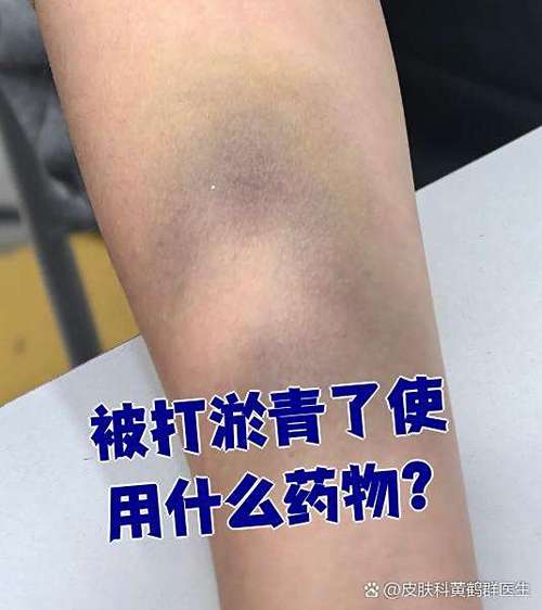 淤青擦什么药好得快