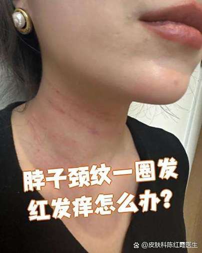 脖子一圈出现红疹子又痒又红