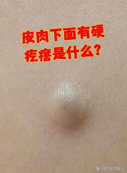 皮下有小硬疙瘩是什么