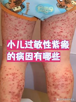 过敏性是什么原因引起的