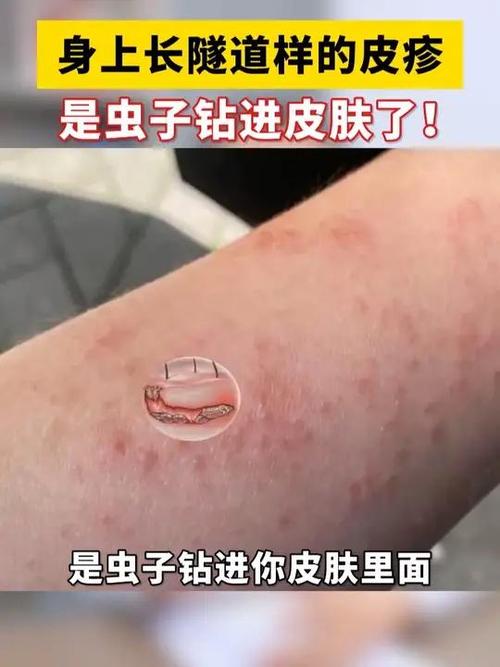身上长虫子图片