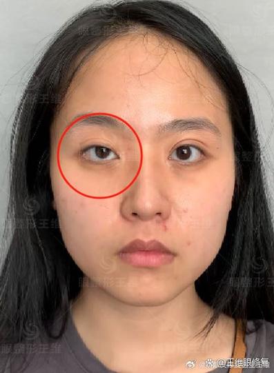 大小眼怎么改善截图