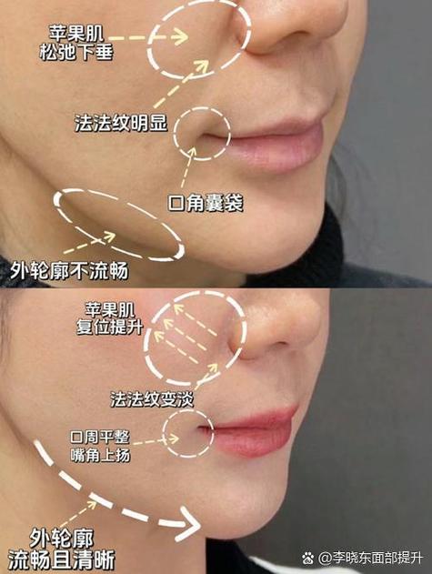 苹果肌下垂提升的最好方法图标
