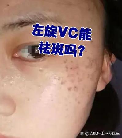 左旋维c片真的能祛斑吗