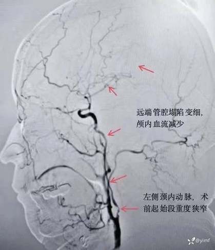 重度狭窄一般寿命多长截图