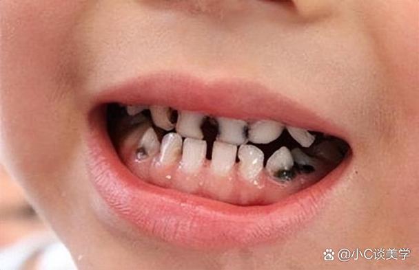 蛀牙去腐但没补会怎么样