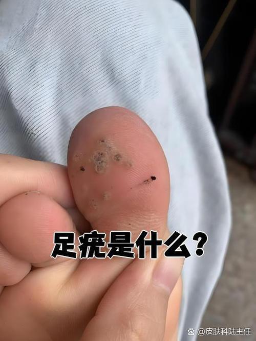 脚上hpv病毒感染图片截图