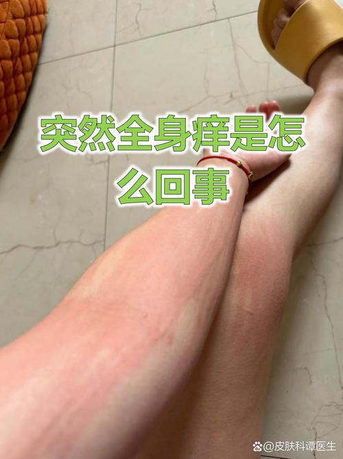 全身痒痒的怎么回事