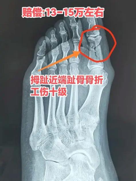 脚趾骨折算几级伤残图标