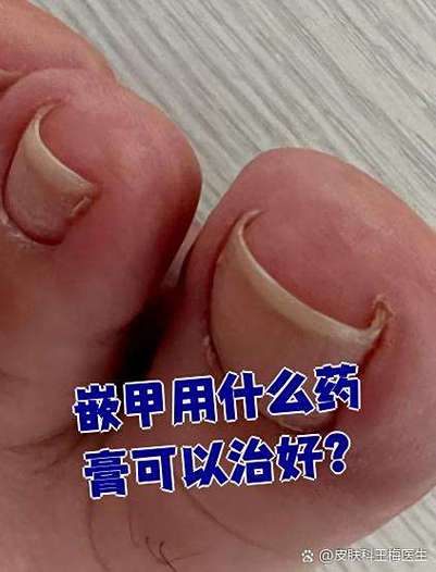 嵌甲的克星红霉素软膏图标