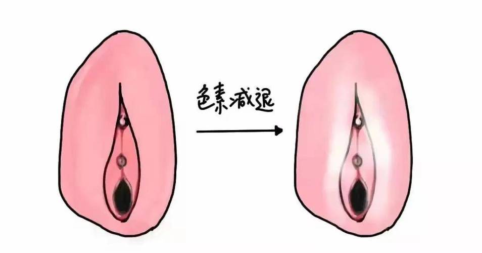 外阴白斑一旦萎缩就很难治吗