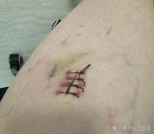 手术缝线容易崩开吗