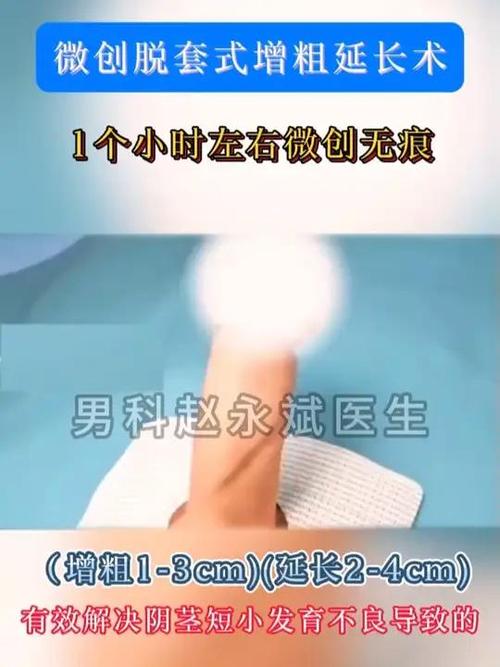 增粗手术费用多少钱截图