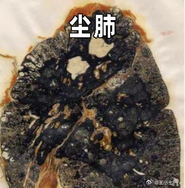 磨床工得尘肺的多不多