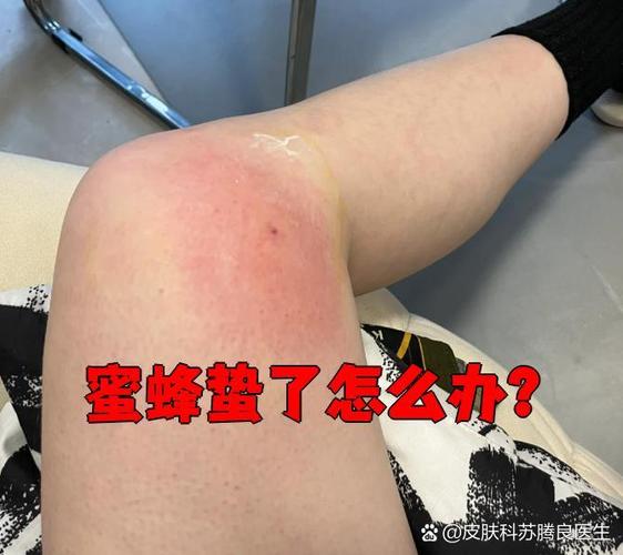 被蜜蜂蛰了涂什么缩略图