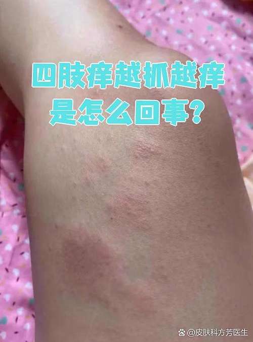身上老痒痒是怎么回事截图