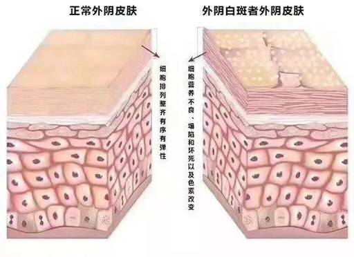 北京著名外阴白斑专家