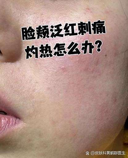 脸上刺痛火辣辣的灼烧感