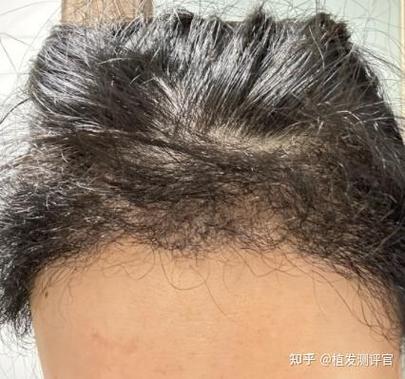 植发有没有什么危害和副作用