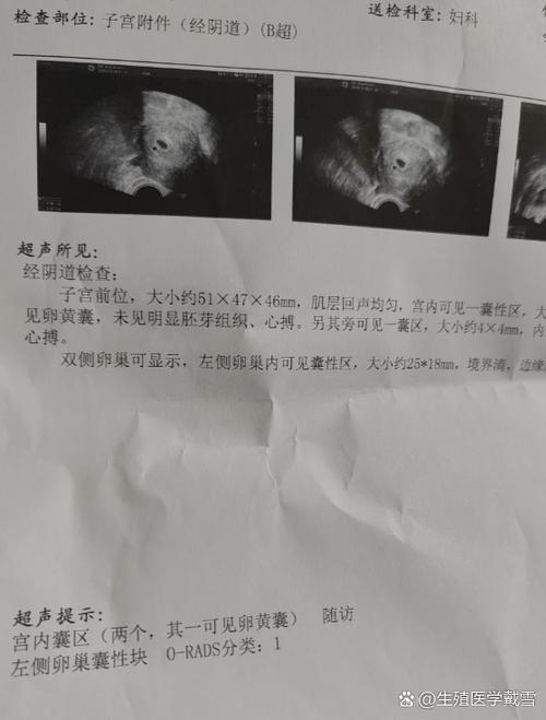 43天没孕囊还只有暗区图标