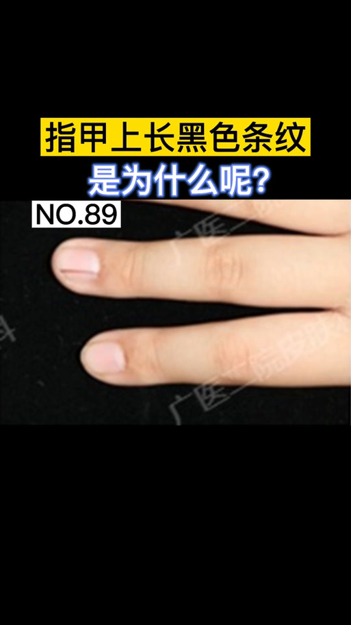 指甲一条黑色竖线