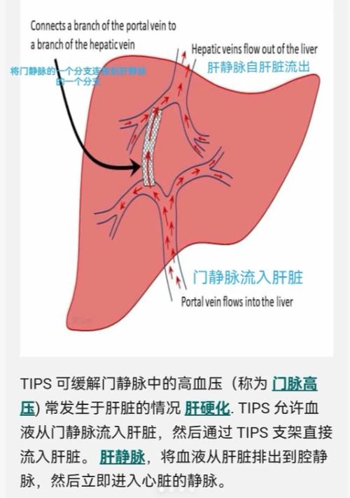 做完分流手术注意什么