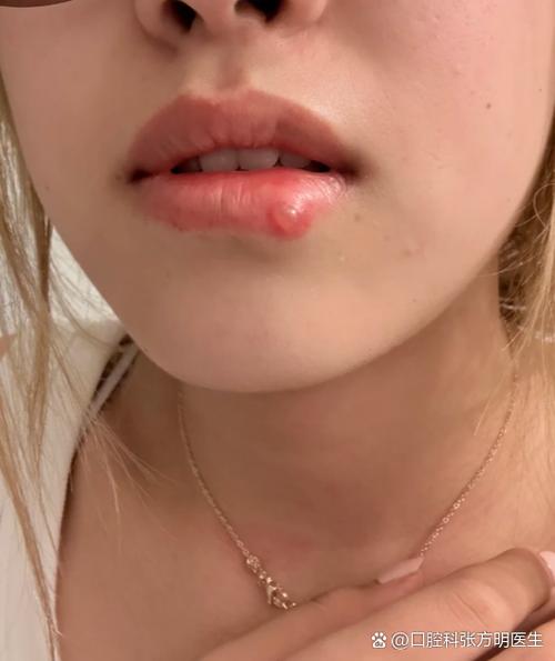 女的说嘴上起泡暗示