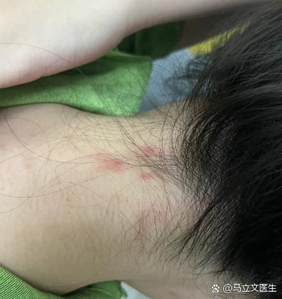 脖子一条红线怎么弄