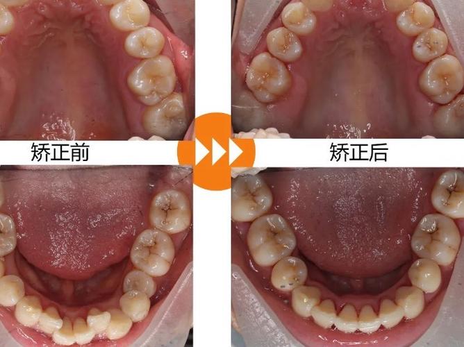 成人牙歪了怎么矫正视频