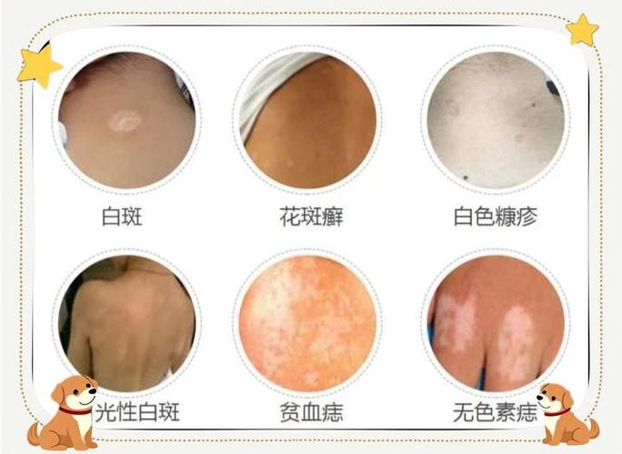 白斑和白癜风的区别怎么分