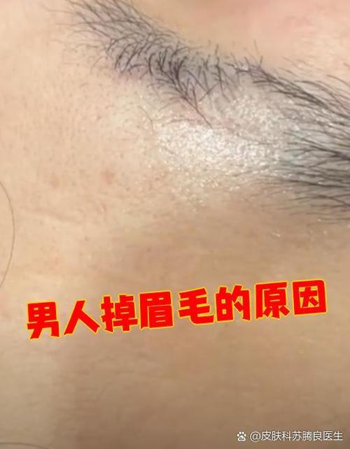 男性掉眉毛的主要原因