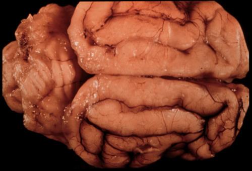 cryptococcosis