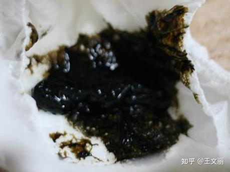 拉屎拉黑色的是怎么回事