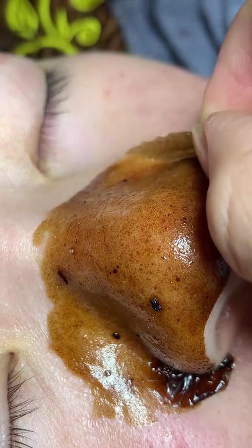祛痘视频