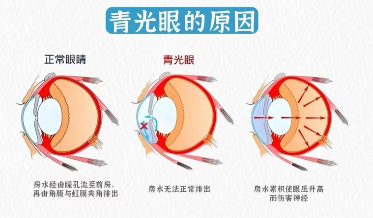 青光眼早期防治ppt
