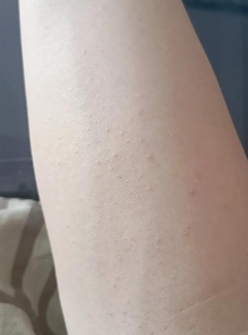 身上长一些小疙瘩不疼不痒