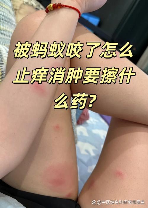 被大蚂蚁咬了会怎么样截图