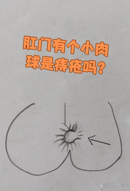 肛门出现肉