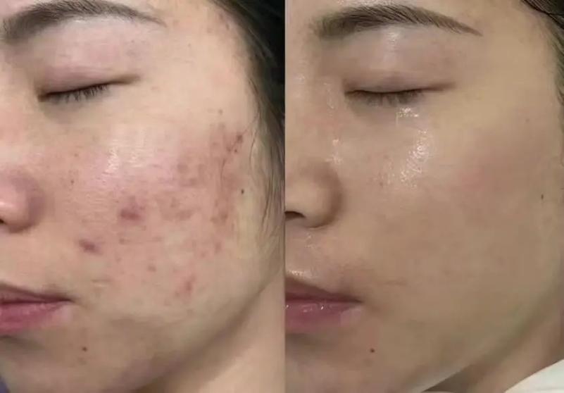 脸上去痘印的最好方法