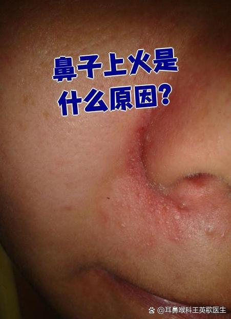 鼻子坏了是什么火
